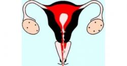 Întrebarea este dacă polipii de col uterin afectează ciclul menstrual
