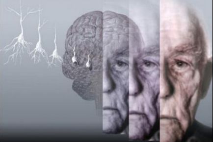 Чи можливо зупинити розвиток хвороби Альцгеймера