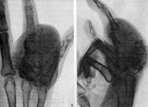 Simptomele osului chondrosarcomului, fotografie, supraviețuire