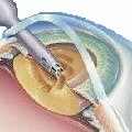 Înlocuirea lentilei cu selecția de cataractă a reconstrucției lentilei artificiale a vederii