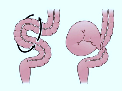 Inversarea simptomelor intestinale și a tratamentului, ce este, cauzele