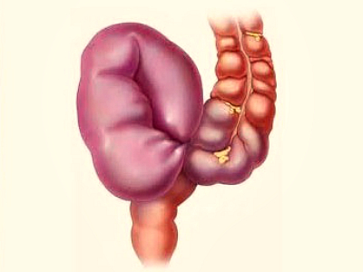Inversiunea simptomelor intestinale și a tratamentului, care sunt cauzele