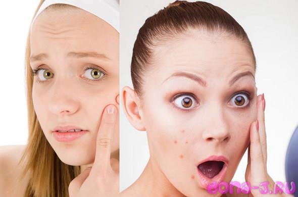 11 Diferite tipuri de acnee și simptomele acestora