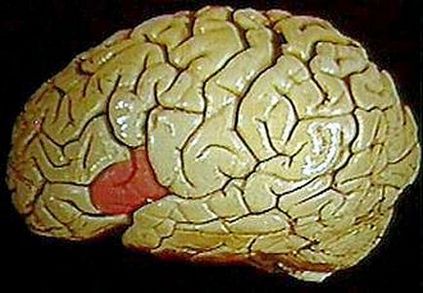 Broca afázia, annak okait és lefolyását (afázia) Broca afázia, annak okait és lefolyását