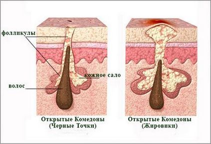 Акнето е това, което е