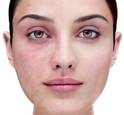 Askorutin rosacea hogyan kell fogadni, visszacsatolás és eredmények