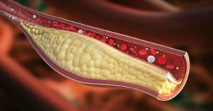 Ateroscleroza plăcilor vasculare și a tulburărilor asociate cu colesterolul