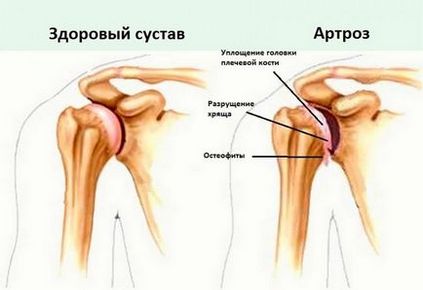 Болить плече при піднятті руки вгору що робити, до якого лікаря йти