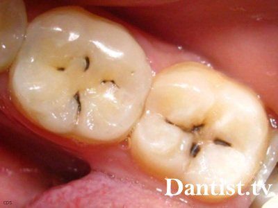 Болить запломбований зуб що робити, причини і лікування
