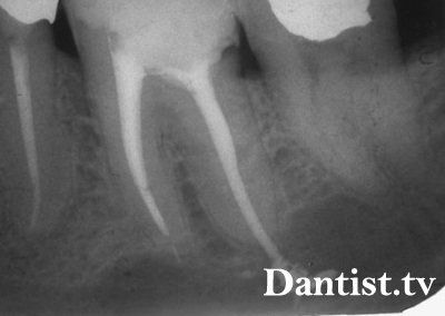 Un dinte sigilat doare ce trebuie să facă, cauze și tratament