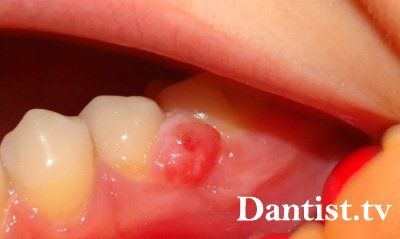 Болить запломбований зуб що робити, причини і лікування