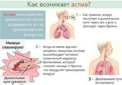 Бронхіальна астма у дітей симптоми і лікування - розвиток дитини