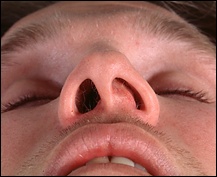 Cептопластіка виправлення носової перегородки, операція по виправленню носової перегородки