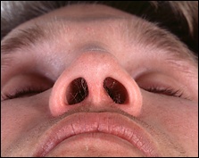 Cептопластіка виправлення носової перегородки, операція по виправленню носової перегородки
