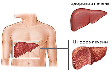 Répa levest tiszta a máj és az epehólyag kövek feloldására