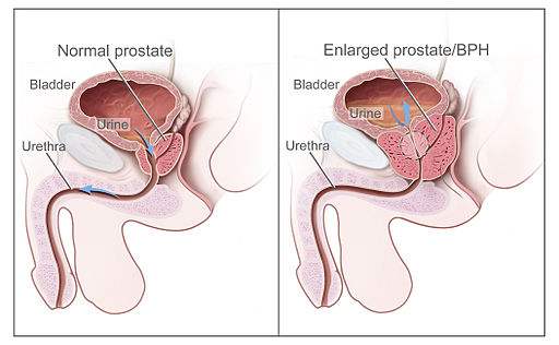 Ce este adenomul prostatic, abc-medicina