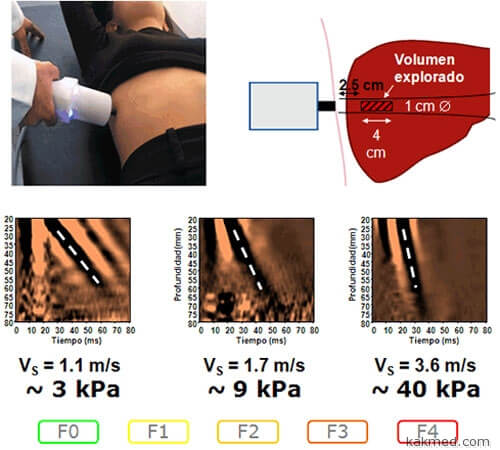 Májzsugorodás most diagnosztizálják nélkül biopszia