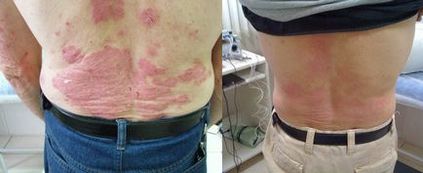 Diéta psoriasis - a diéta chart a héten (lásd a táblázatot) Diéta psoriasis - a diéta chart a héten