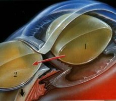Extragerea extracapsulară a chirurgiei cataractului (eek), recenzii, clinici, prețuri