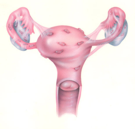 Az endometriózis kezelési művelet