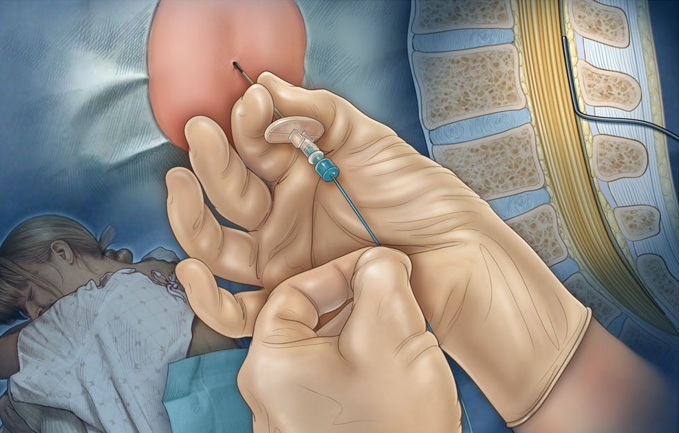 Anestezia epidurala in timpul nasterii
