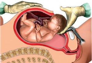 Epidurális érzéstelenítés szülés közben