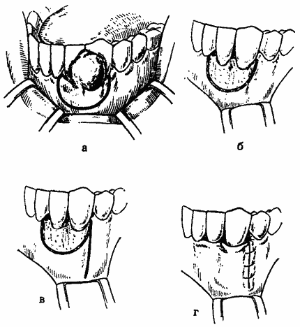 Epulis, tumori odontogene și formațiuni asemănătoare tumorii, stomatologie chirurgicală