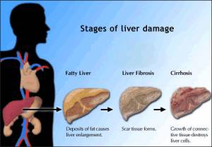 Fibroscan - înlocuirea biopsiei hepatice