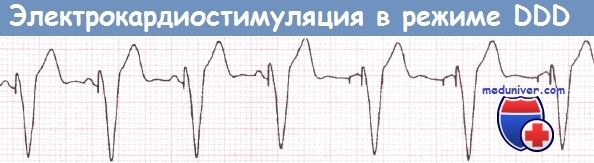 Фізіологічні системи електрокардіостимуляції (екс)