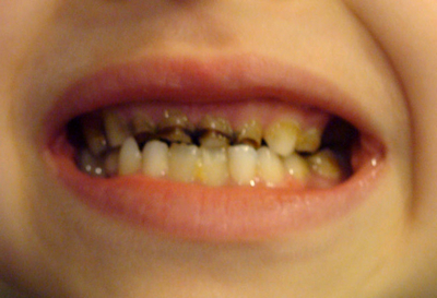 Formarea și dezvoltarea dinților