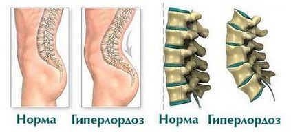 Hyperlordoza cauzele, diagnosticul, tratamentul