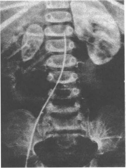 Hypoplasia rinichiului la nou-născut și codul adulților de către μB-10, cauze, simptome, tratament