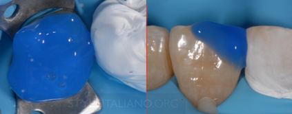 Giulio pavolucci - 50 відтінків тефлону в стоматології - частина 1