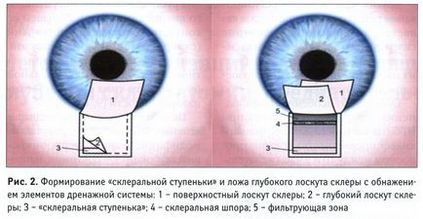 Glaukóma szem, mi ez, a kezelés és a tünetek