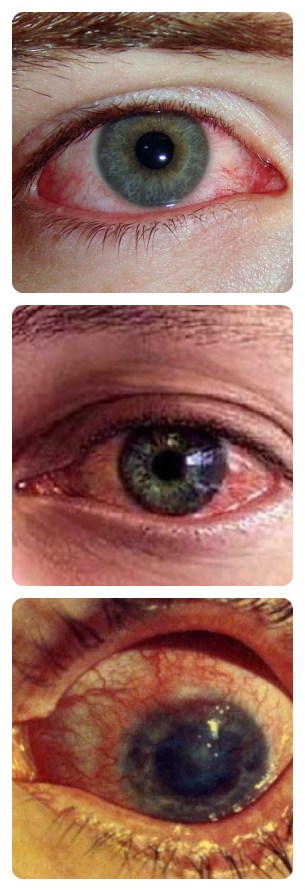 Picături de ochi din alergii - pe care să le alegeți