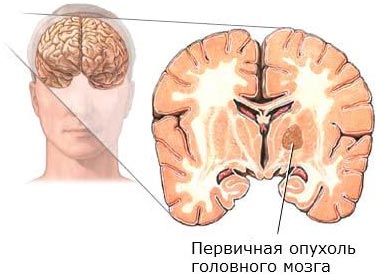 Головний мозок - види пухлин