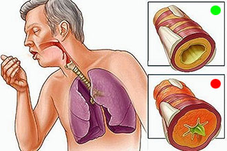 Гірчичники при болю в горлі - як їх можна правильно ставити