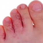 Грибок пальців ніг причини, симптоми, лікування, фото