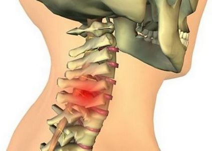 Hernia coloanei vertebrale cervicale ocupă locul doi în prevalența dintre toate tipurile de hernie