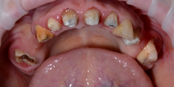 Імплантація зубів нижній новгород ціни, відгуки, порівняння вартості послуг стоматології