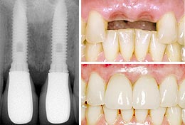 Імплантація зубів - тов «стоматологічний центр Куркіно»