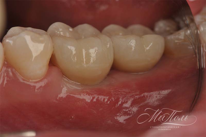 Імплантація зубів під ключ в Куркино і Хімках, вартість