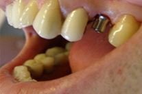 Імплантація зубів в Москві ціна, види, фото, відгуки -асоціація стоматологів