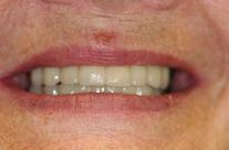 Implantul de dinți la prețul de la Moscova, vizualizări, fotografii, recenzii - Asociația dentiștilor