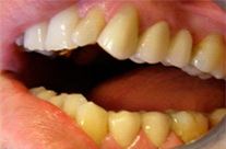 Імплантація зубів в Москві ціна, види, фото, відгуки -асоціація стоматологів
