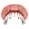 Implantul de dinți la prețul de la Moscova, vizualizări, fotografii, recenzii - Asociația dentiștilor