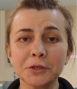 Irina Agibalova înainte și după operația plastică