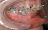 Segítségével microimplants fogszabályozási
