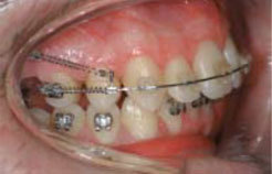 Використання мікроімплантів в ортодонтії