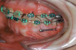 Використання мікроімплантів в ортодонтії